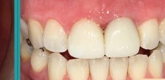 Before and after photos of an old crown replaced with new porcelain crowns — after