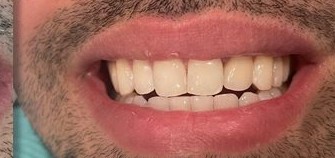 Before and after photos of space closure with aligners and veneers — after