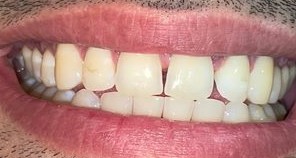 Before and after photos of space closure with aligners and veneers — before