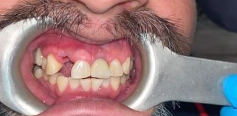 Before and after photos of missing teeth replaced with dental implants — before