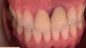 Before and after photos of an old crown replaced with new porcelain crowns — before