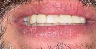 Before and after photos of missing teeth replaced with dental implants — after